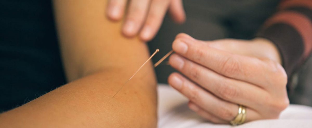 Acupuncture Therapy | Cloverdale Physiotherapy and Sports Injury Clinic