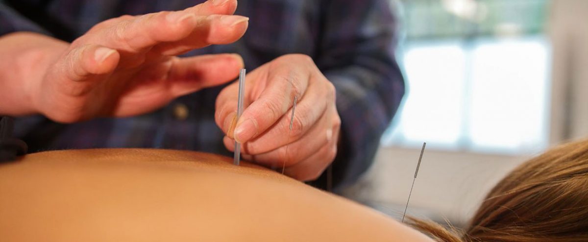 Traditional Chinese Medicine Acupuncture | TCM Therapy | Cloverdale Physiotherapy and Sports Injury Clinic